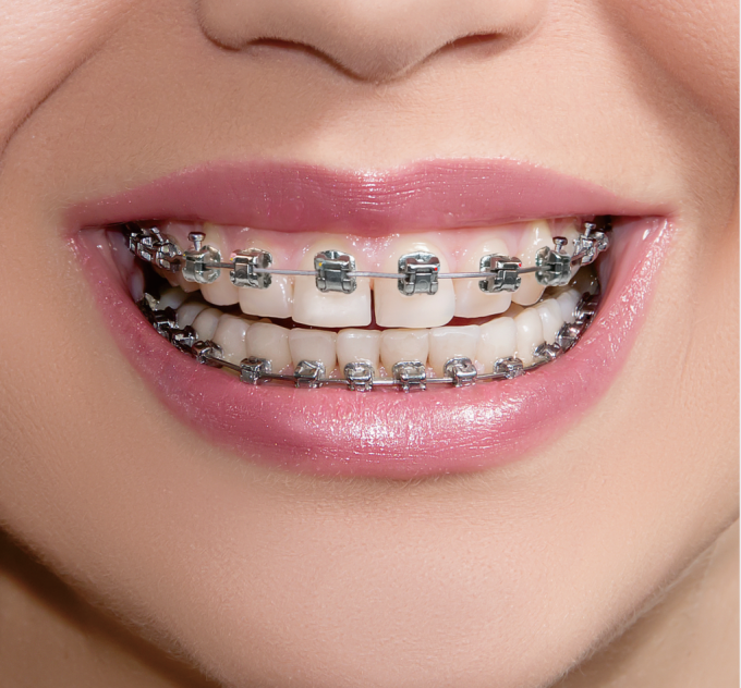 Stainless Steel MBT Orthodontic Metal Brackets 0.022'' 0.018''